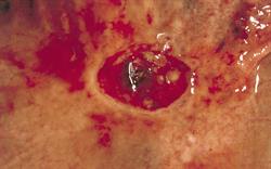 Nicorandil use restricted over ulceration risk