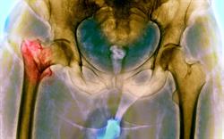 NICE updates guidance on use of bisphosphonates in osteoporosis
