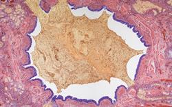 NICE approves reslizumab for severe eosinophilic asthma