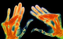 Arthritis treatment options widened with launch of anti-IL-6 antibody