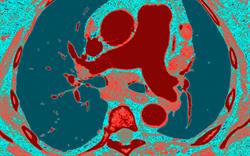 Selexipag: new class of treatment for pulmonary artery hypertension reaches prescribers
