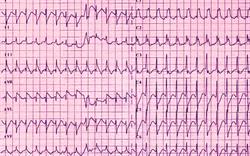 Cardiac warning for anticholinergic injection