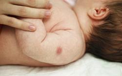BCG vaccine supply issues prompt calls to reduce wastage