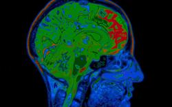 Galantamine: reports of serious skin reactions
