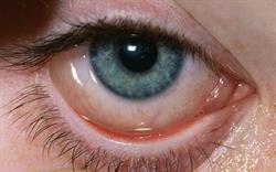 Increased reports of eye irritation with Xalatan