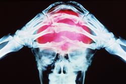 NICE approves Botox for migraine prophylaxis