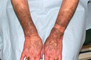 Pictorial Case Study: Drug-induced Dyspigmentation | GPonline