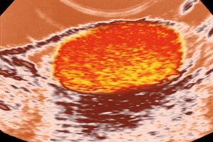 Clinical Solutions - Haematospermia | GPonline