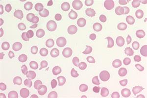 Haematology - Thrombotic thrombocytopenic purpura | GPonline