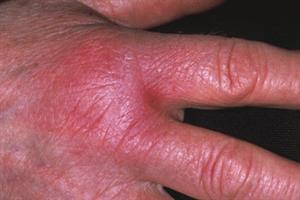 Evidence base: Cellulitis and erysipelas | GPonline