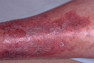 Lower Leg Eczema: Differential Diagnosis 