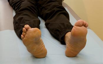 SGLT2 inhibitors associated with increased risk of lower-limb amputation in new study