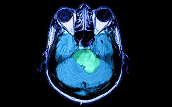 First treatment for primary progressive MS launched
