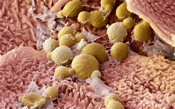 NICE approves apremilast for refractory psoriasis