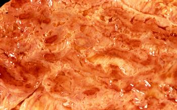 Ulcerative colitis treatment recommended by NICE