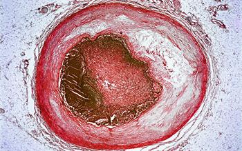 Update: GPs warned about error in cardiovascular risk calculator