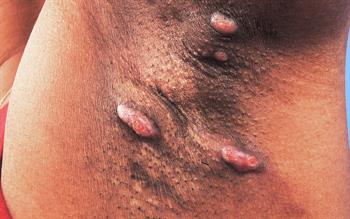 Hidradenitis suppurativa treatment accepted for NHS use