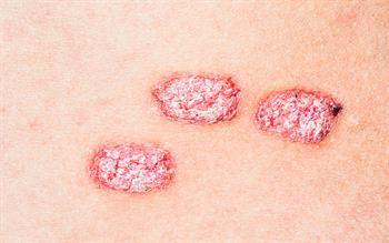 New vitamin D/steroid combination foam for psoriasis