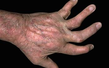 Psychiatric advice issued for psoriasis treatment
