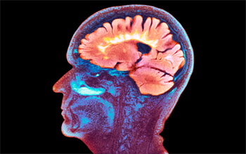 First oral short-course treatment for MS