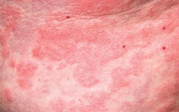 Improve your diagnostic skills and knowledge of skin conditions