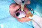 Ranibizumab gains NICE approval for secondary macular oedema