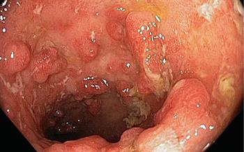 New biologic option for Crohn's disease