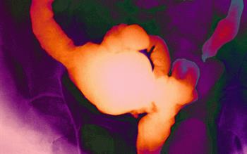 NICE approves alternative biologic for Crohn's disease