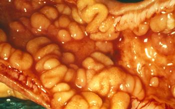 NICE approves vedolizumab for Crohn's disease