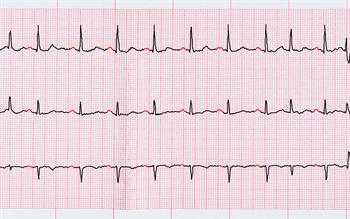 Print-out of an electrocardiogram (ECG) showing paroxsyms of atrial fibrillation.
