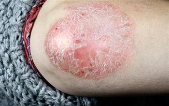Topical psoriasis treatment to be available without a prescription