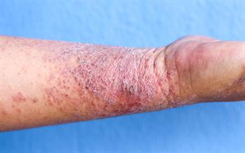 Dupilumab: first biologic for moderate-to-severe atopic dermatitis