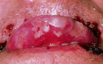 Risk of serious skin reactions with anaemia drugs