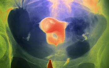 Do not start any new course of ulipristal for fibroids, MHRA advises