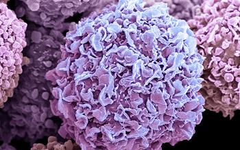 Pink/purple coloured scanning electron micrograph of breast cancer cells