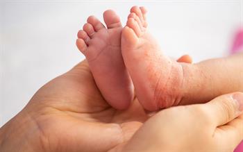 Close up image of adult hands holding two babies feet with eczema