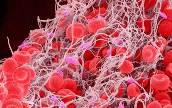 Scanning electron micrograph image of a blood clot with violet coloured platelets and orange coloured blood cells.