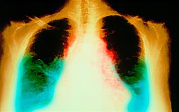 Quadruple therapy should be 'new therapeutic standard' for heart failure, say researchers