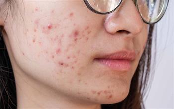 A young women's cheek with acne 