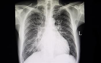 Second SGLT2 inhibitor approved for heart failure