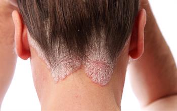 Psoriasis biologic approved for NHS prescribing
