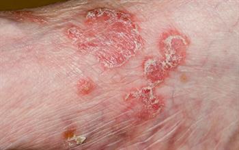 Brodalumab: a new biologic for moderate-to-severe plaque psoriasis
