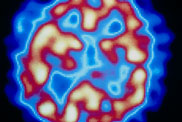 Latuda: new atypical antipsychotic