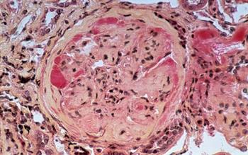 Launch of new SGLT2 inhibitor increases choice in diabetes prescribing
