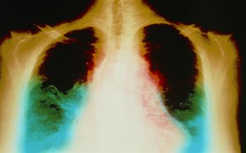 'Innovative' heart failure treatment approved by NICE