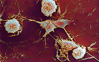 Novel MS drug gains NICE approval