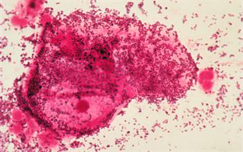 Dequalinium chloride: new topical treatment for bacterial vaginosis