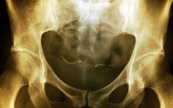 'No evidence of patient safety risk' with controversial sterilisation device, says MHRA