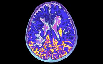 MS treatment to be withdrawn over safety concerns