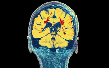 First glatiramer generic available to prescribe for MS